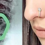 ناک کی بالی کا ٹکڑا خاتون کے پھیھپڑوں میں پھنس گیا